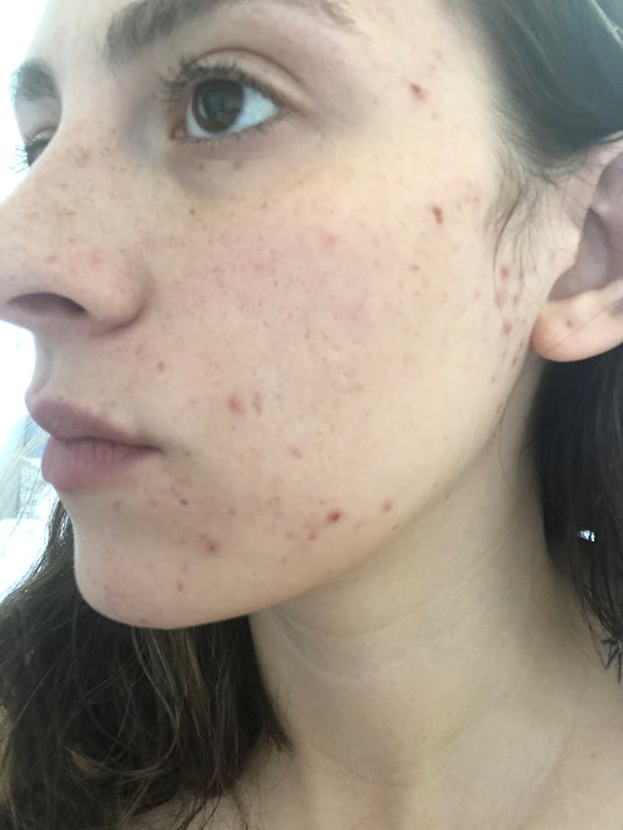 Skin Purging & Breakouts Are Different Beasts — & Here’s Why