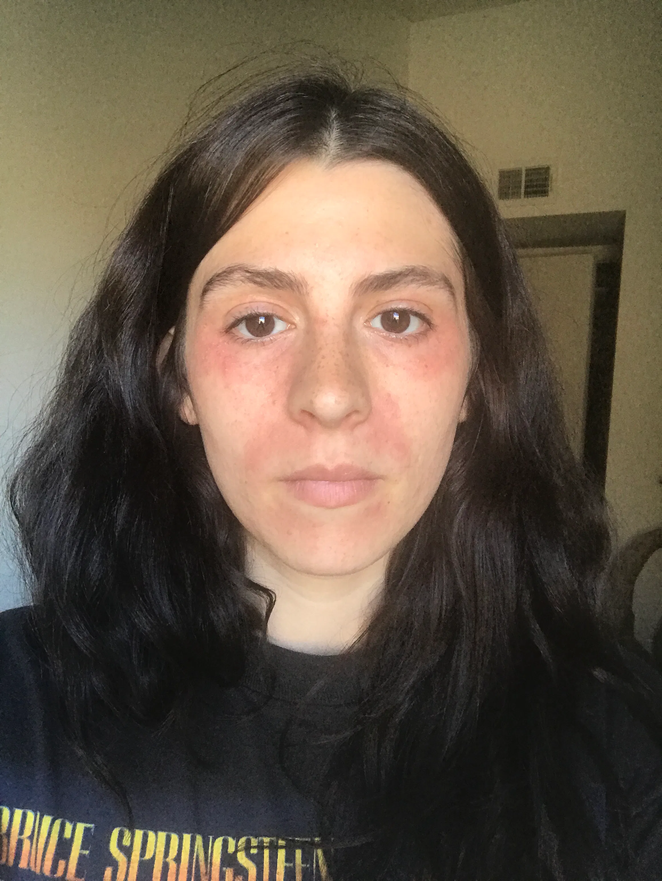 weleda calendula cream for perioral dermatitis